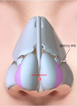 Method Ⅰ — 코 연골 3D 일러스트, 코끝 중앙 a 선과 '줄어드는 부위' 분홍 표시