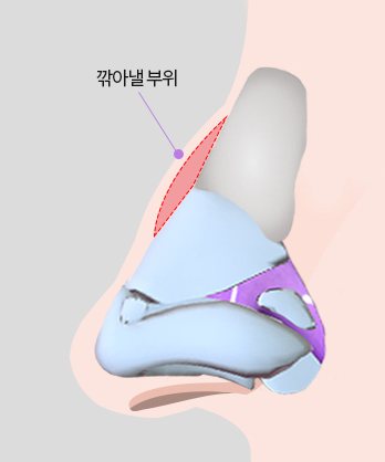 Method Ⅶ 비개방 삭골술 — 코 옆모습 연골 일러스트, 콧등 '깎아낼 부위' 빨간 빗금