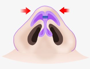 STEP2 연골재배치 — 양옆 빨간 화살표로 벌어진 연골을 모으는 코 밑면 일러스트