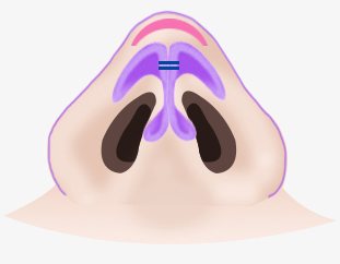 STEP3 이식 — 코끝 위 분홍 이식 부위를 표시한 코 밑면 일러스트
