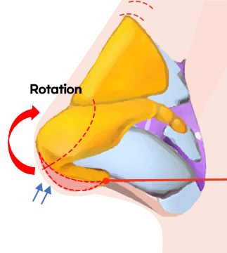 Method Ⅲ 코끝 회전술 — 코 옆모습 연골 일러스트, 빨간 'Rotation' 회전 화살표