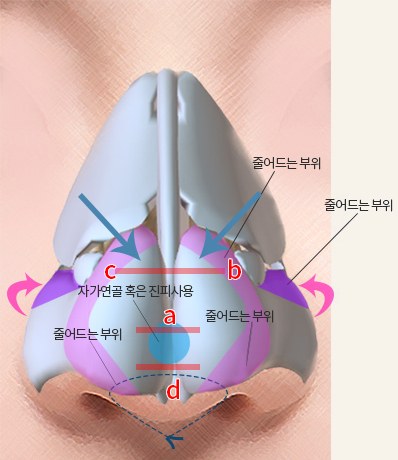 Method Ⅴ — 코 연골 3D 일러스트, 콧날개 분홍 화살표·a·b·c·d 선과 '자가연골 혹은 진피사용', '줄어드는 부위' 꼬리표