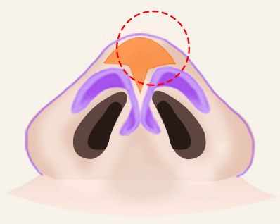 코 밑면 일러스트 — 코끝 섬유질(SMAS) 부위를 주황색과 빨간 점선 동그라미로 표시
