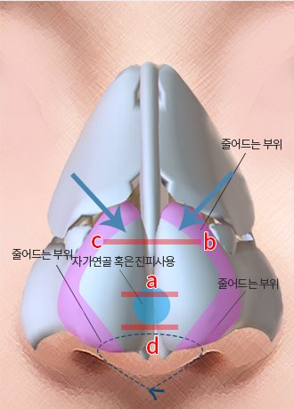 Method Ⅳ — 코 연골 3D 일러스트, a·b·c·d 선과 '자가연골 혹은 진피사용' 파란 표시, '줄어드는 부위' 꼬리표