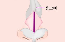 휜코 — 코 정면 코뼈 도식, '휜코뼈' 꼬리표