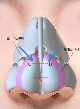Method Ⅱ — 코 연골 3D 일러스트, a·b·c 선과 파란 화살표, '줄어드는 부위' 표시