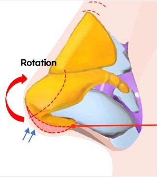 Method Ⅲ 코끝 회전술 — 코 옆모습 연골 일러스트, 빨간 'Rotation' 회전 화살표