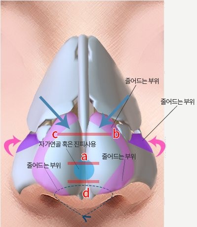 Method Ⅴ — 코 연골 3D 일러스트, 콧날개 분홍 화살표·a·b·c·d 선과 '자가연골 혹은 진피사용', '줄어드는 부위' 꼬리표
