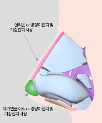 Method Ⅵ 비개방 콧대성형+코끝 연장술 — 코 옆모습 연골 일러스트, 콧등 이식재(분홍)와 코끝 이식(초록) 꼬리표