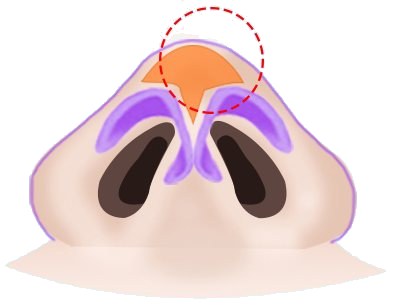 코 밑면 일러스트 — 코끝 섬유질(SMAS) 부위를 주황색과 빨간 점선 동그라미로 표시, 오른쪽에 '비개방식의 섬유질(SMAS) 제거' 꼬리표